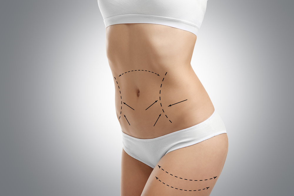 Are You a Candidate For Liposuction?