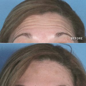 hiers september botox before and after